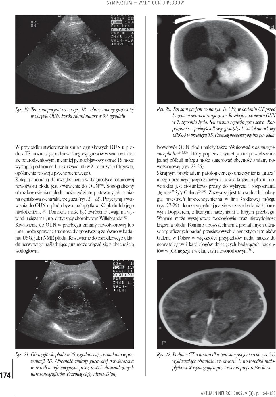 roku życia lub w 2. roku życia (drgawki, opóźnienie rozwoju psychoruchowego). Kolejną anomalią do uwzględnienia w diagnostyce różnicowej nowotworu płodu jest krwawienie do OUN (50).