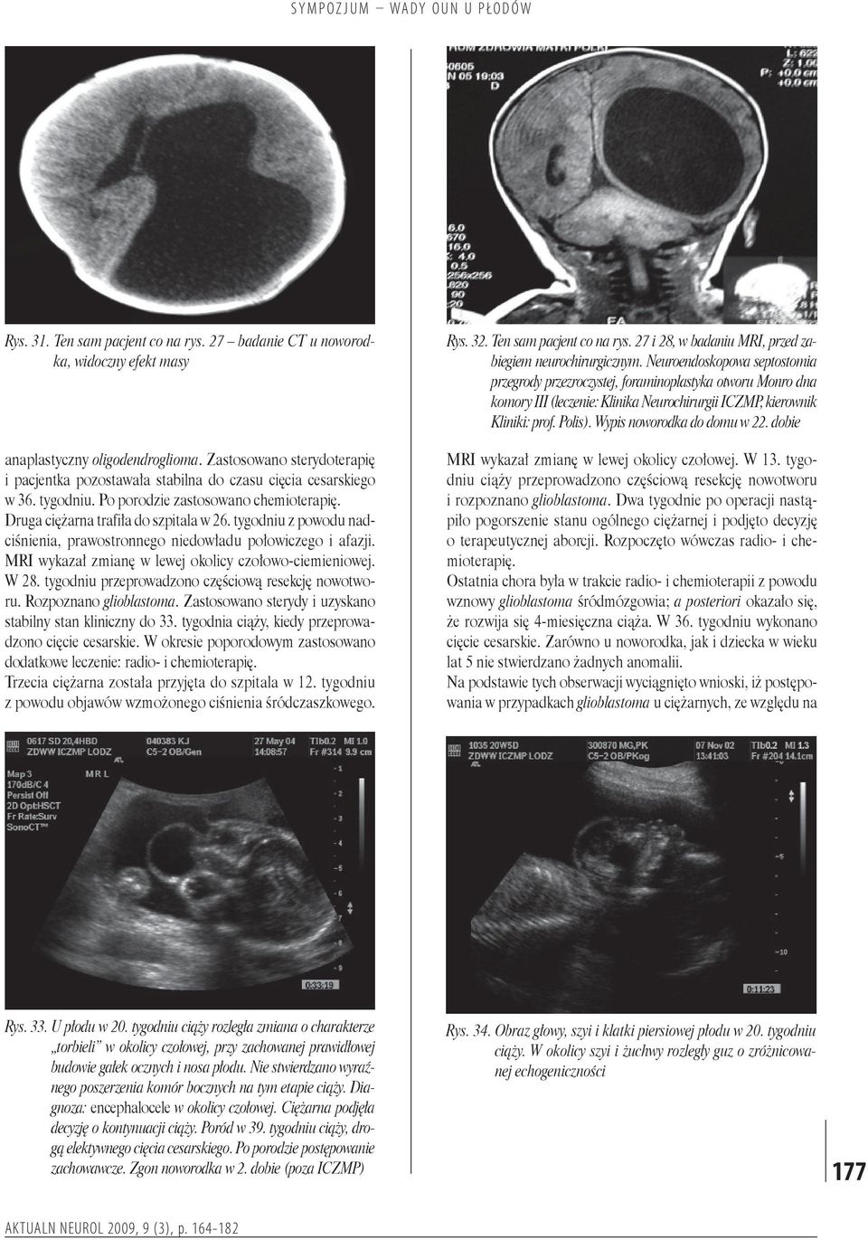 tygodniu z powodu nadciśnienia, prawostronnego niedowładu połowiczego i afazji. MRI wykazał zmianę w lewej okolicy czołowo-ciemieniowej. W 28. tygodniu przeprowadzono częściową resekcję nowotworu.