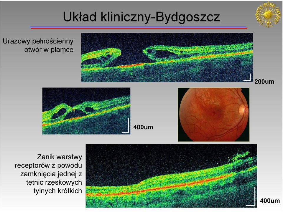 Zanik warstwy receptorów z powodu