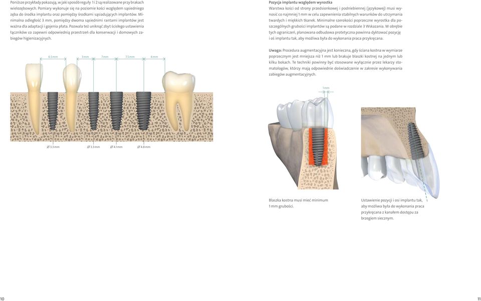 Minimalna odległość 3 mm, pomiędzy dwoma sąsiednimi rantami implantów jest ważna dla adaptacji i gojenia płata.