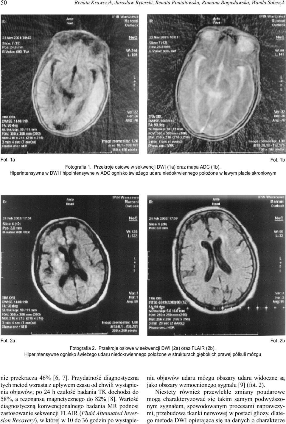 Hiperintensywne ognisko œwie ego udaru niedokrwiennego po³o one w strukturach g³êbokich prawej pó³kuli mózgu Fot. 2b nie przekracza 46% [6, 7].