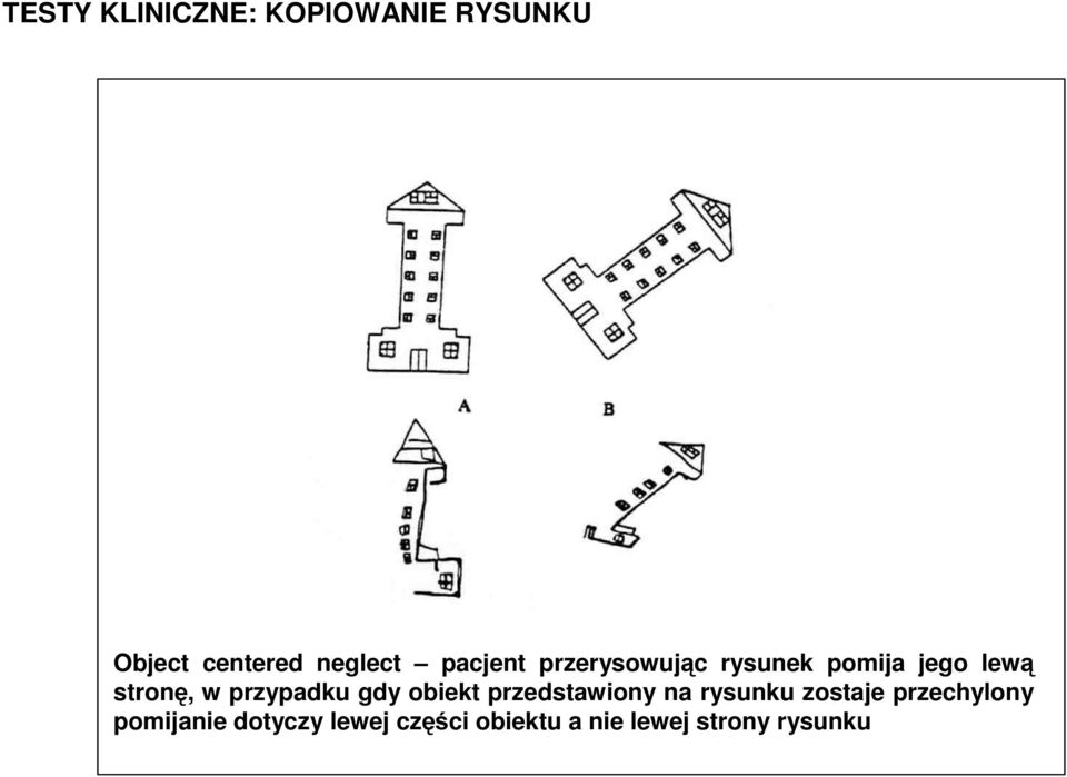 Same patient copies the right side of the tower when it is tilted, rather than the left half of space.