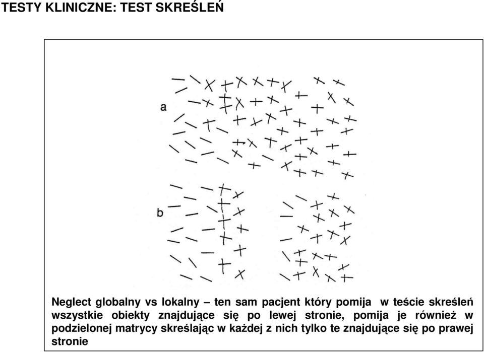 każdej z nich tylko te znajdujące się po prawej stronie Global vs focal neglect: Same patient that neglects