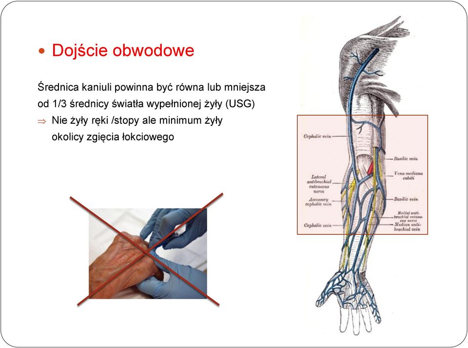 światła wypełnionej żyły (USG) Nie żyły