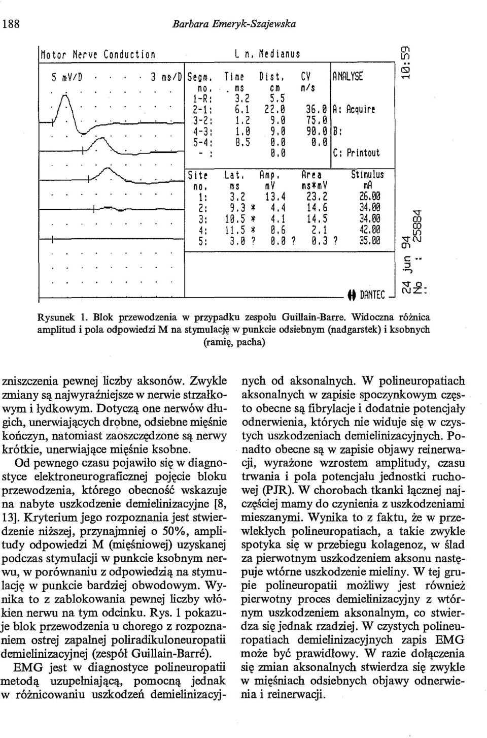 1 42.00 5: 3.0? e. e? 0.3? 35.00 fł DANTEC - ~~ c: :l..., Rysunek l. Blok przewodzenia w przypadku zespołu Guillain-Barre.