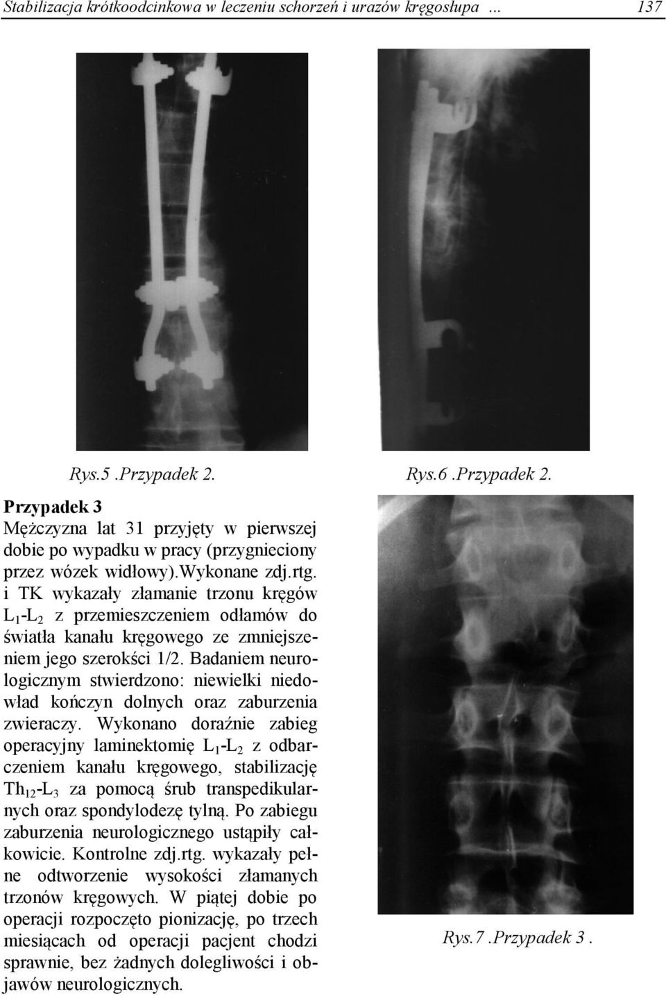 i TK wykazały złamanie trzonu kręgów L 1 -L 2 z przemieszczeniem odłamów do światła kanału kręgowego ze zmniejszeniem jego szerokści 1/2.
