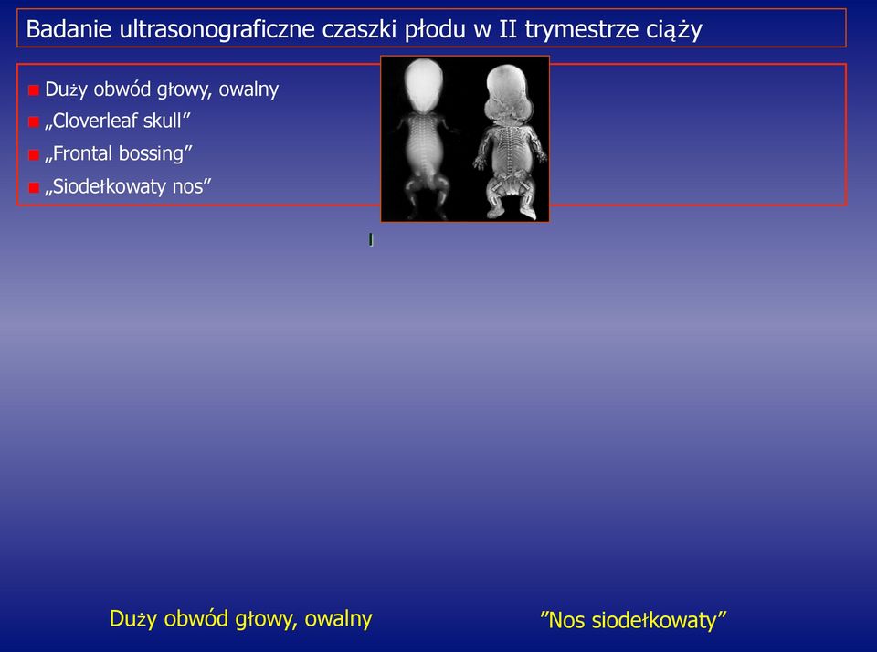 Cloverleaf skull Frontal bossing Siodełkowaty