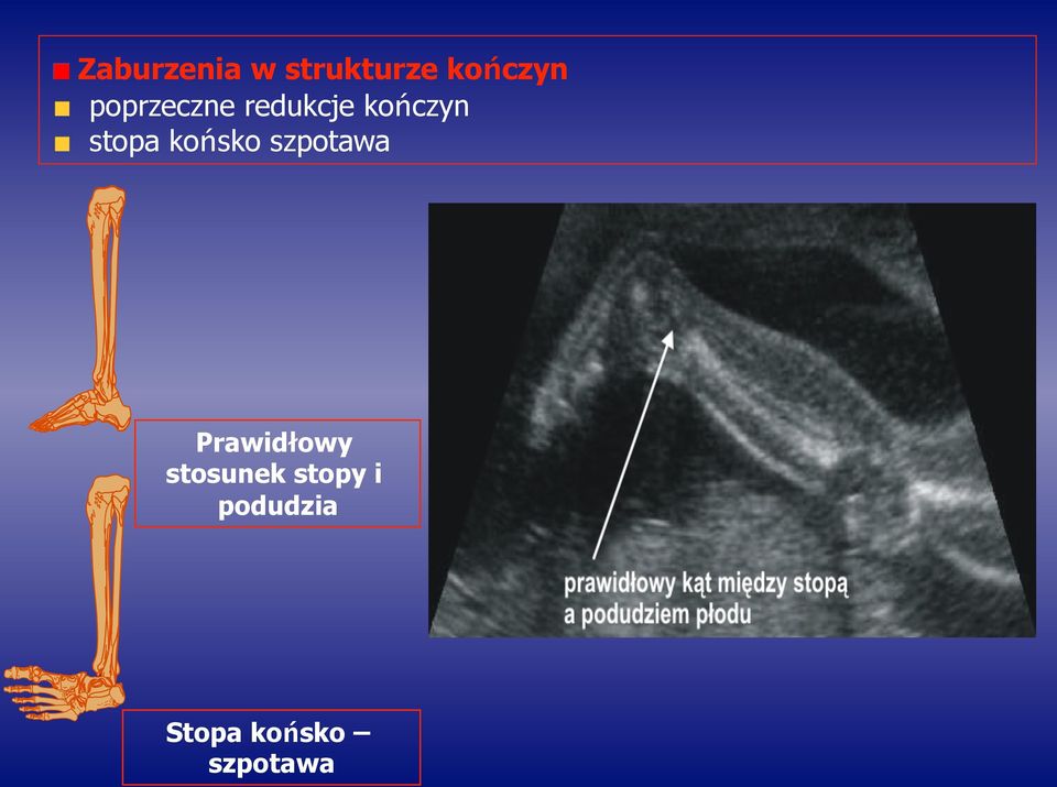 końsko szpotawa Prawidłowy