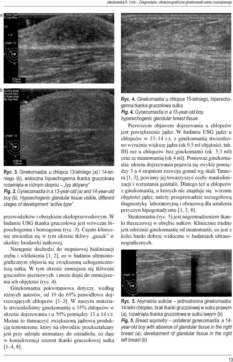 Gynecomastia in a 13-year-old (a) and 14-year-old boy (b). Hypoechogenic glandular tissue visible, different stages of development active type przewodzików i obrzękiem okołoprzewodowym.