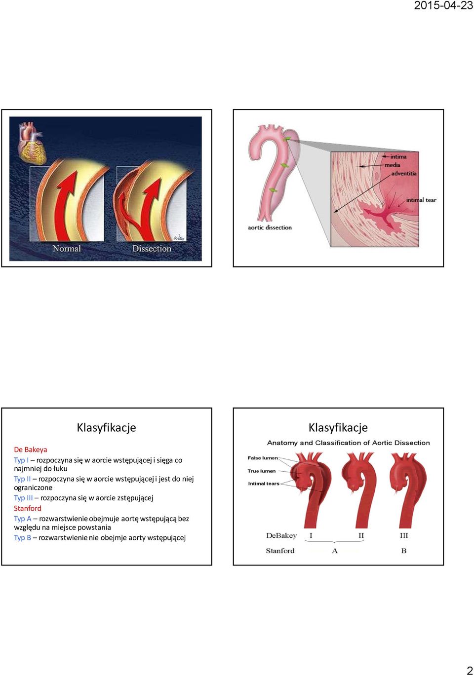 rozpoczyna się w aorcie zstępującej Stanford Typ A rozwarstwienie obejmuje aortę