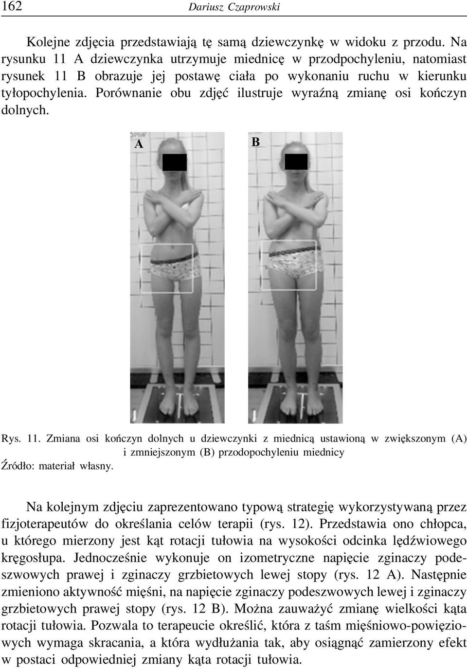 Porównanie obu zdjęć ilustruje wyraźną zmianę osi kończyn dolnych. A B Rys. 11.