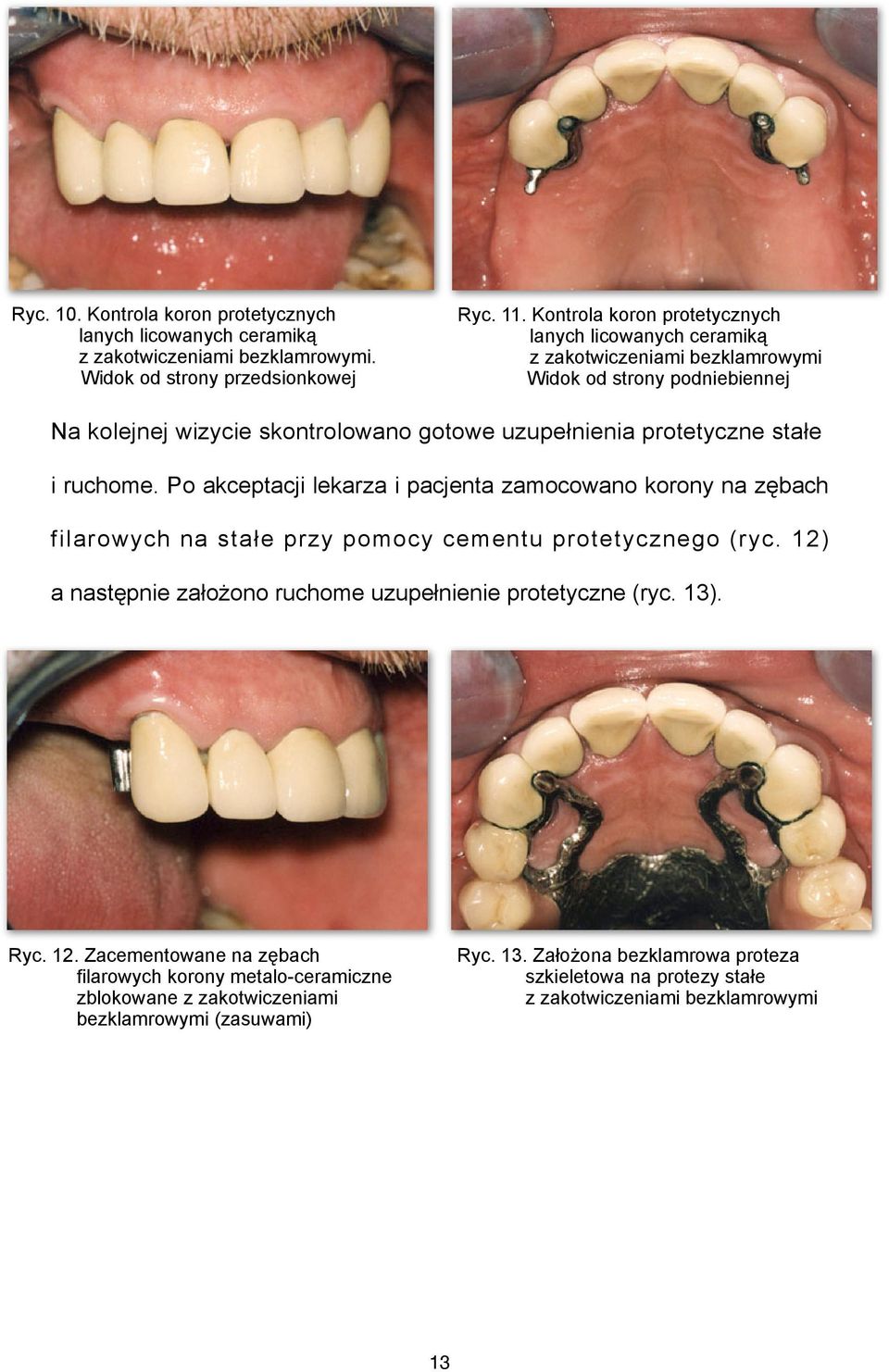 stałe i ruchome. Po akceptacji lekarza i pacjenta zamocowano korony na zębach filarowych na stałe przy pomocy cementu protetycznego (ryc.