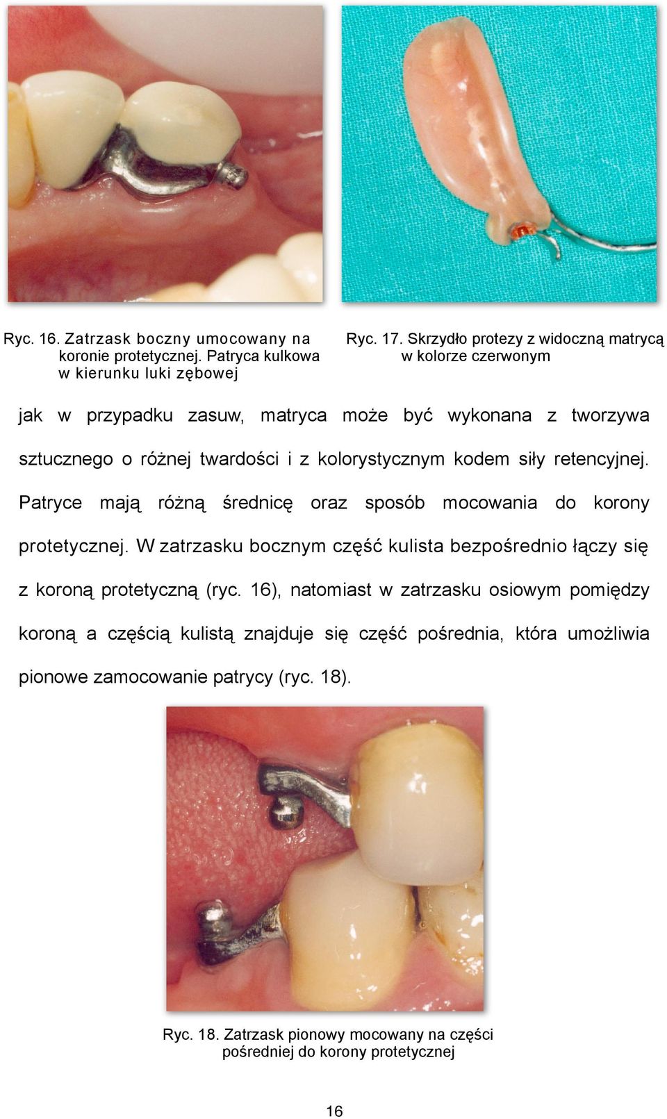 siły retencyjnej. Patryce mają różną średnicę oraz sposób mocowania do korony protetycznej.