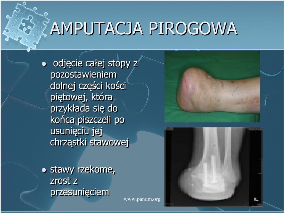 która przykłada się do końca piszczeli po