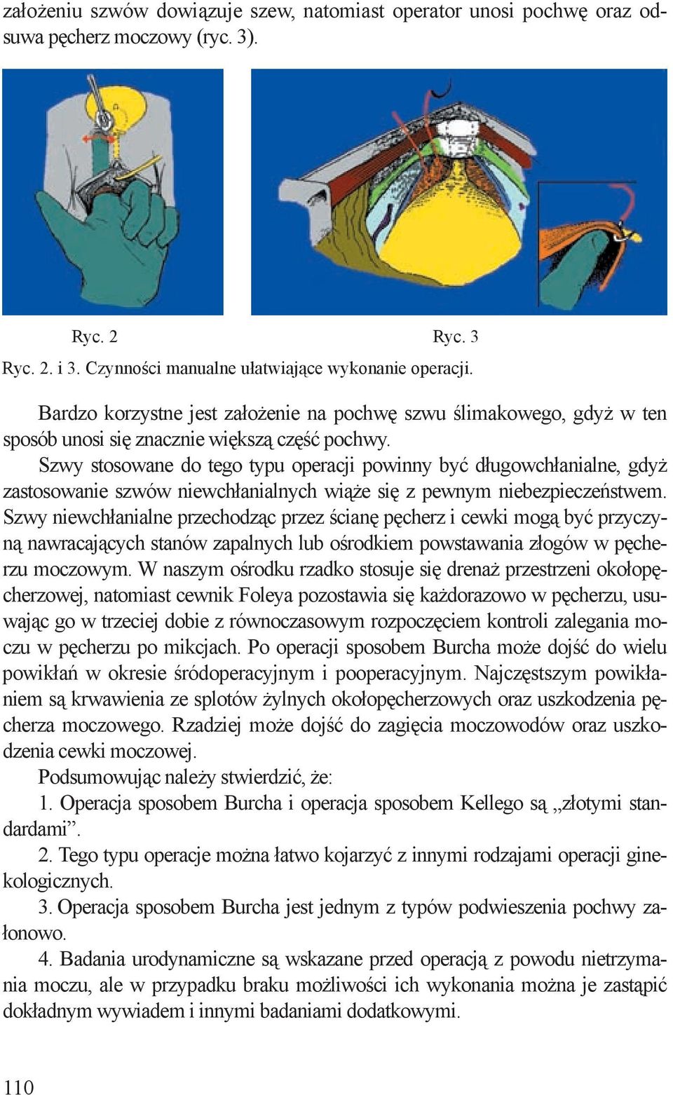 Szwy stosowane do tego typu operacji powinny być długowchłanialne, gdyż zastosowanie szwów niewchłanialnych wiąże się z pewnym niebezpieczeństwem.