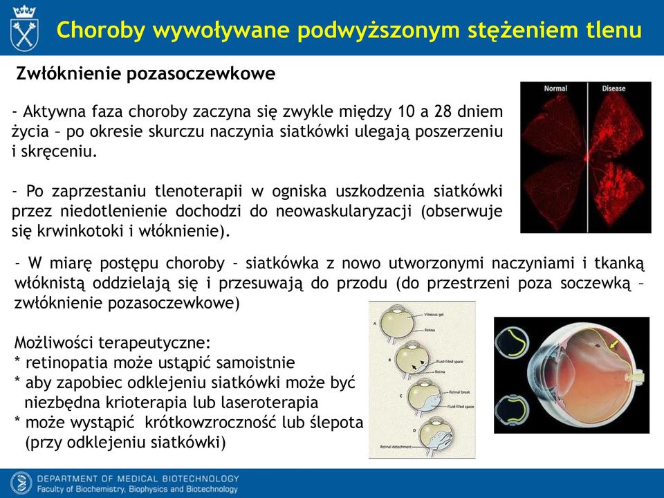 - W miarę postępu choroby - siatkówka z nowo utworzonymi naczyniami i tkanką włóknistą oddzielają się i przesuwają do przodu (do przestrzeni poza soczewką zwłóknienie pozasoczewkowe) Możliwości