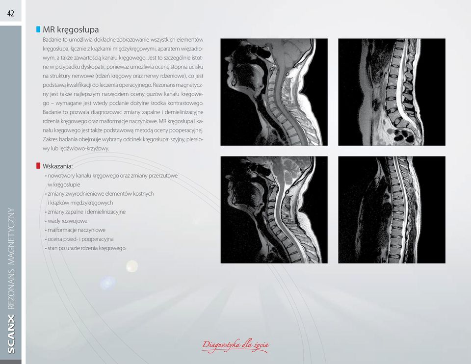 operacyjnego. Rezonans magnetyczny jest także najlepszym narzędziem oceny guzów kanału kręgowego wymagane jest wtedy podanie dożylne środka kontrastowego.