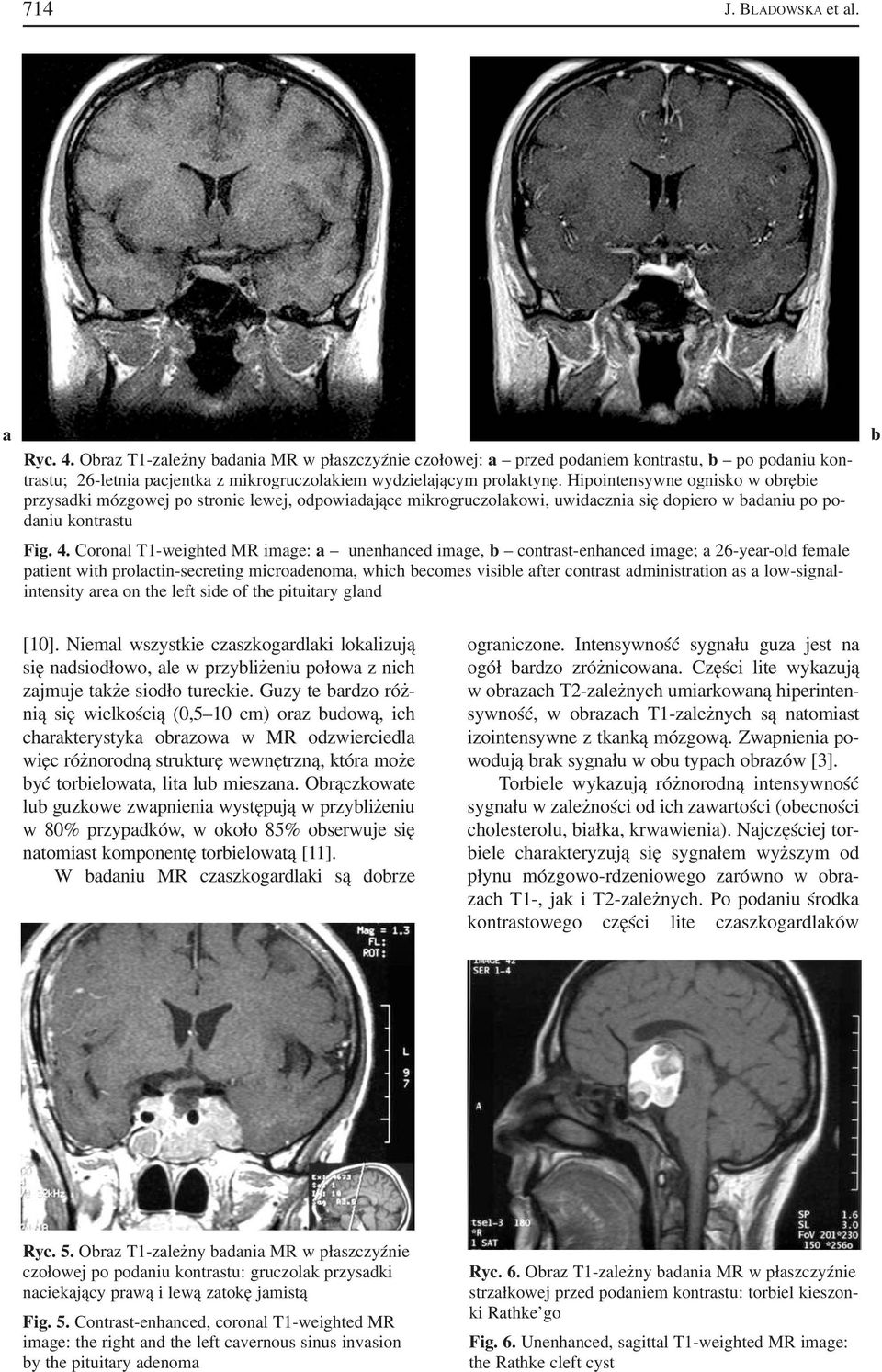 Hipointensywne ognisko w obrębie przysadki mózgowej po stronie lewej, odpowiadające mikrogruczolakowi, uwidacznia się dopiero w badaniu po po daniu kontrastu Fig. 4.