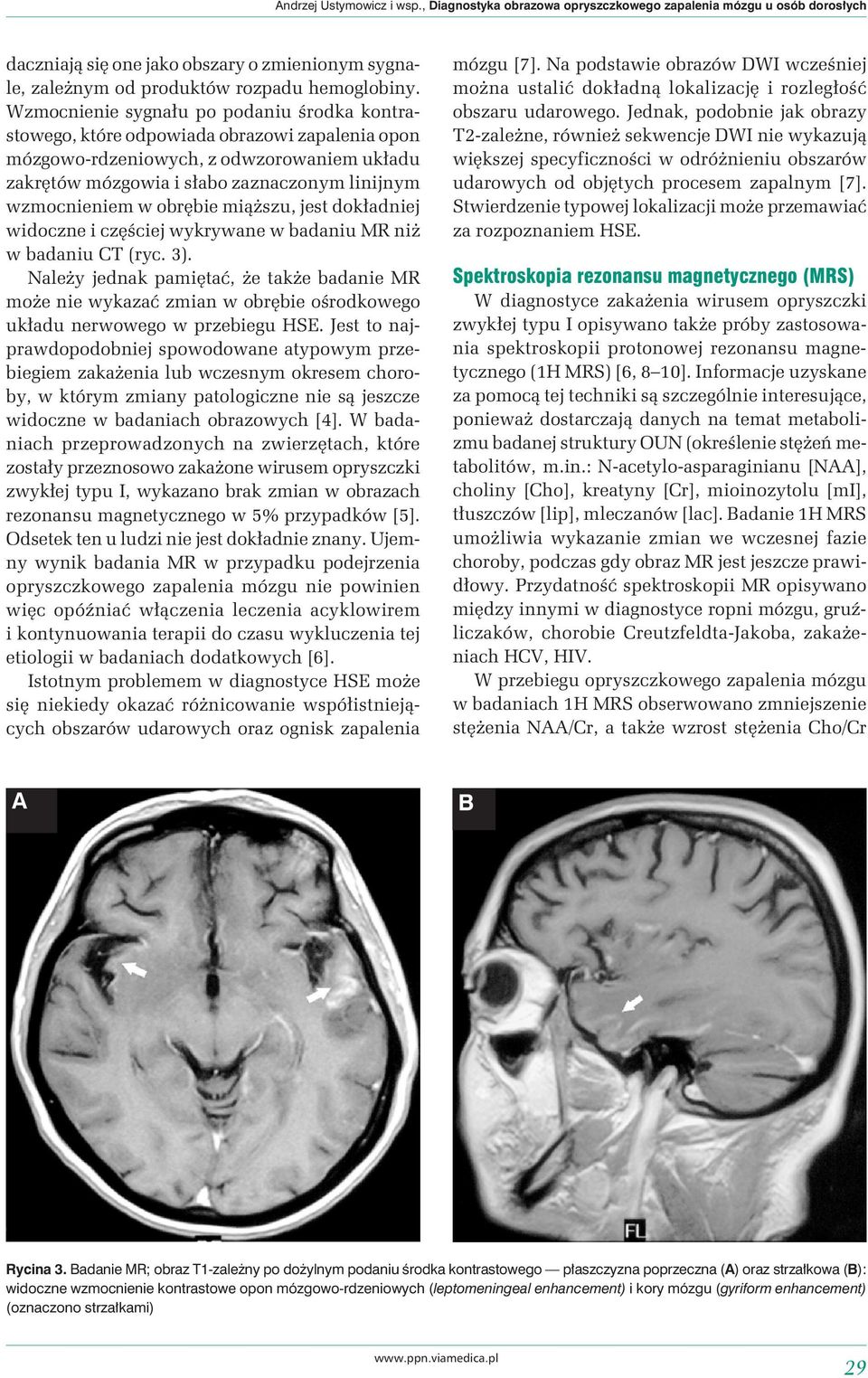 obrębie miąższu, jest dokładniej widoczne i częściej wykrywane w badaniu MR niż w badaniu CT (ryc. 3).