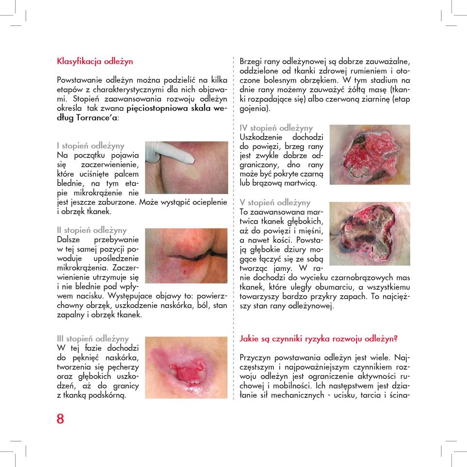 etapie mikrokrążenie nie jest jeszcze zaburzone. Może wystąpić ocieplenie i obrzęk tkanek. II stopień odleżyny Dalsze przebywanie w tej samej pozycji powoduje upośledzenie mikrokrążenia.