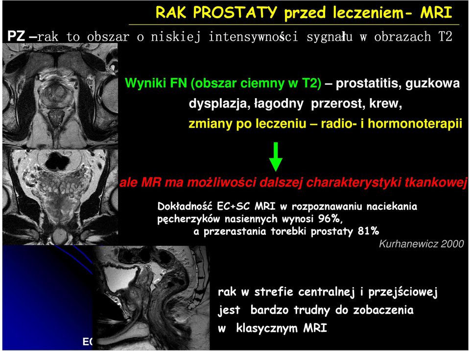 dalszej charakterystyki tkankowej SC Dokładność EC+SC MRI w rozpoznawaniu naciekania pęcherzyków nasiennych wynosi 96%, a