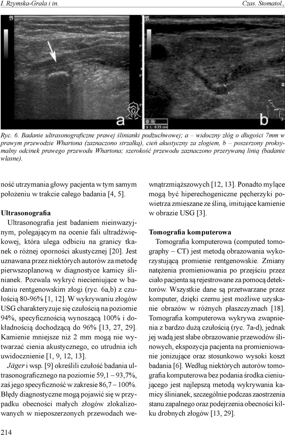 odcinek prawego przewodu Whartona; szerokość przewodu zaznaczono przerywaną linią (badanie własne). ność utrzymania głowy pacjenta w tym samym położeniu w trakcie całego badania [4, 5].