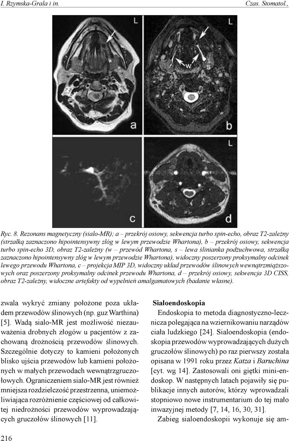 turbo spin-echo 3D, obraz T2-zależny (w przewód Whartona, s lewa ślinianka podżuchwowa, strzałką zaznaczono hipointensywny złóg w lewym przewodzie Whartona), widoczny poszerzony proksymalny odcinek