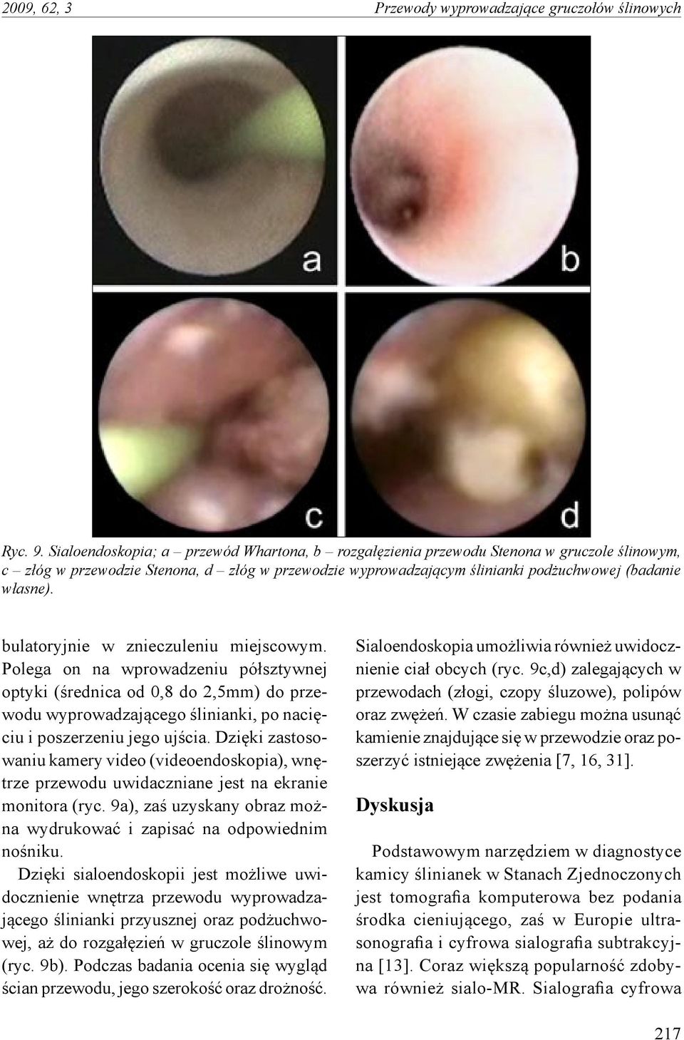 bulatoryjnie w znieczuleniu miejscowym. Polega on na wprowadzeniu półsztywnej optyki (średnica od 0,8 do 2,5mm) do przewodu wyprowadzającego ślinianki, po nacięciu i poszerzeniu jego ujścia.