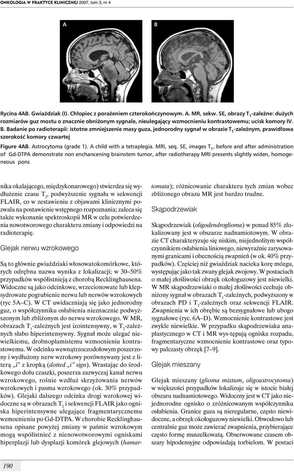 . adanie po radioterapii: istotne zmniejszenie masy guza, jednorodny sygnał w obrazie T 1 -zależnym, prawidłowa szerokość komory czwartej Figure 4. strocytoma (grade 1). child with a tetraplegia.