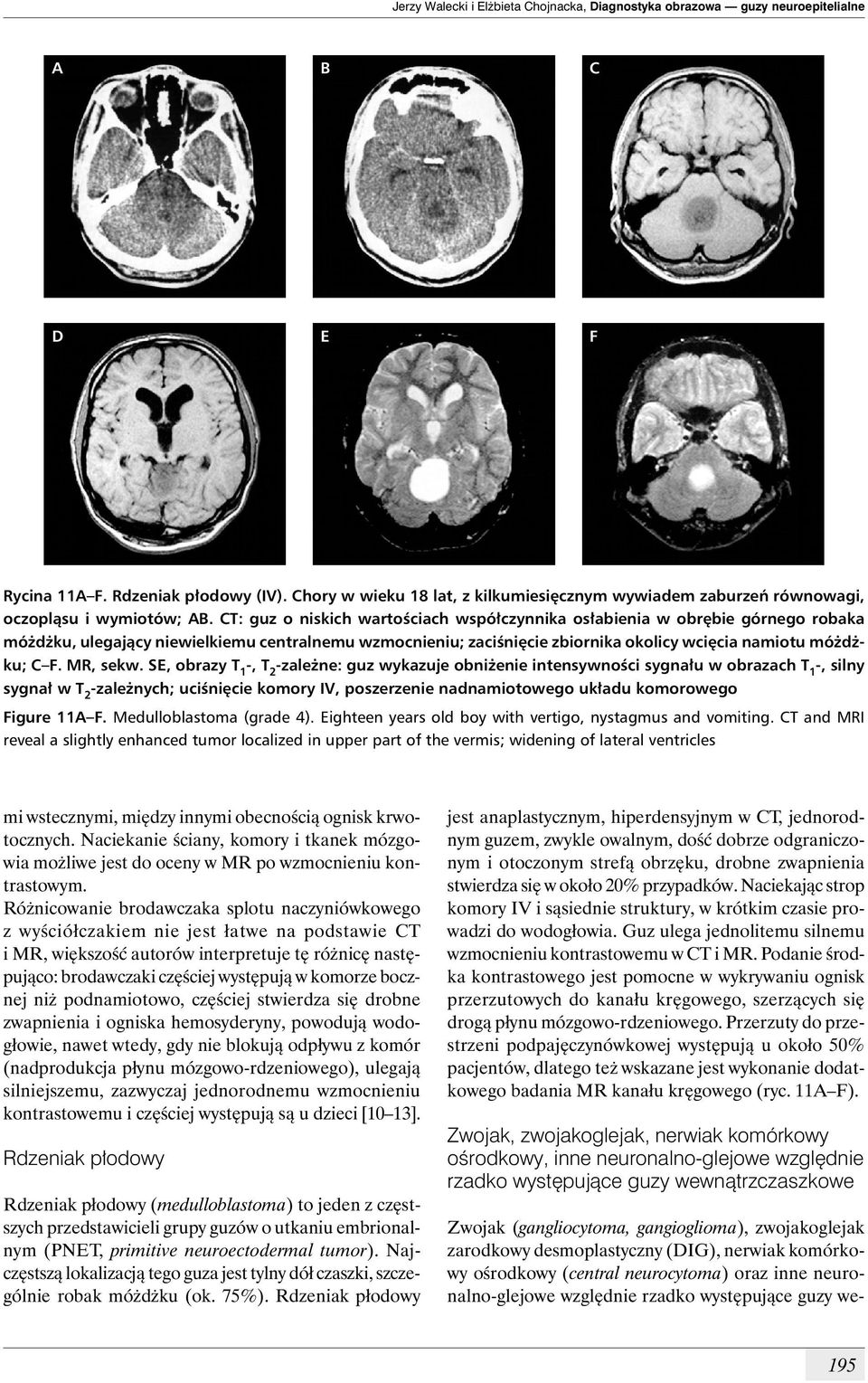 CT: guz o niskich wartościach współczynnika osłabienia w obrębie górnego robaka móżdżku, ulegający niewielkiemu centralnemu wzmocnieniu; zaciśnięcie zbiornika okolicy wcięcia namiotu móżdżku; C F.