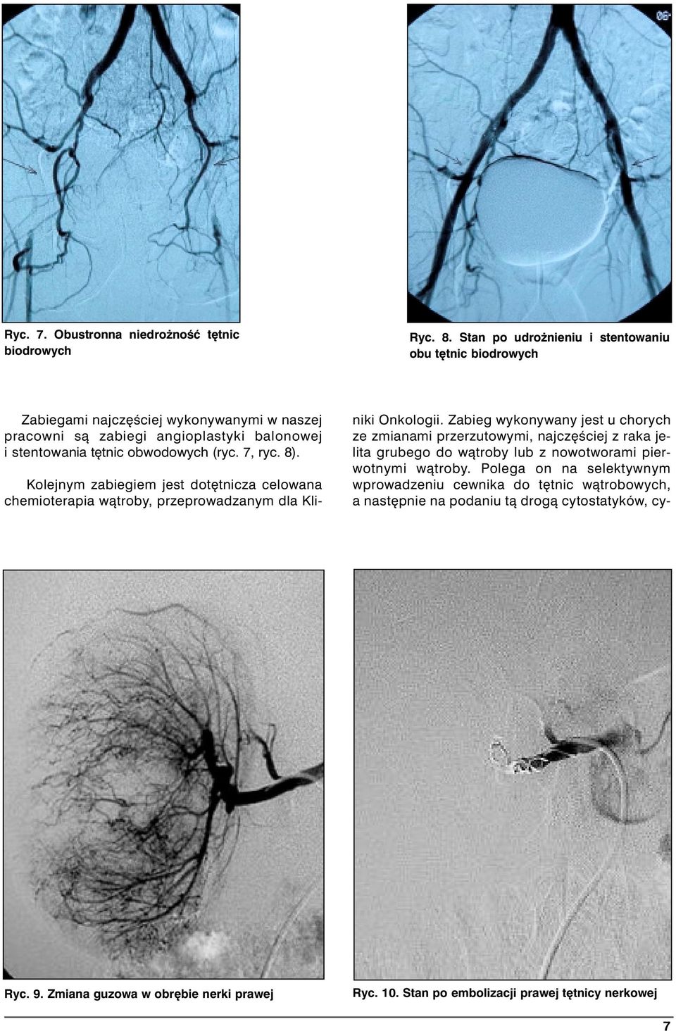(ryc. 7, ryc. 8). Kolejnym zabiegiem jest dot tnicza celowana chemioterapia wàtroby, przeprowadzanym dla Kliniki Onkologii.
