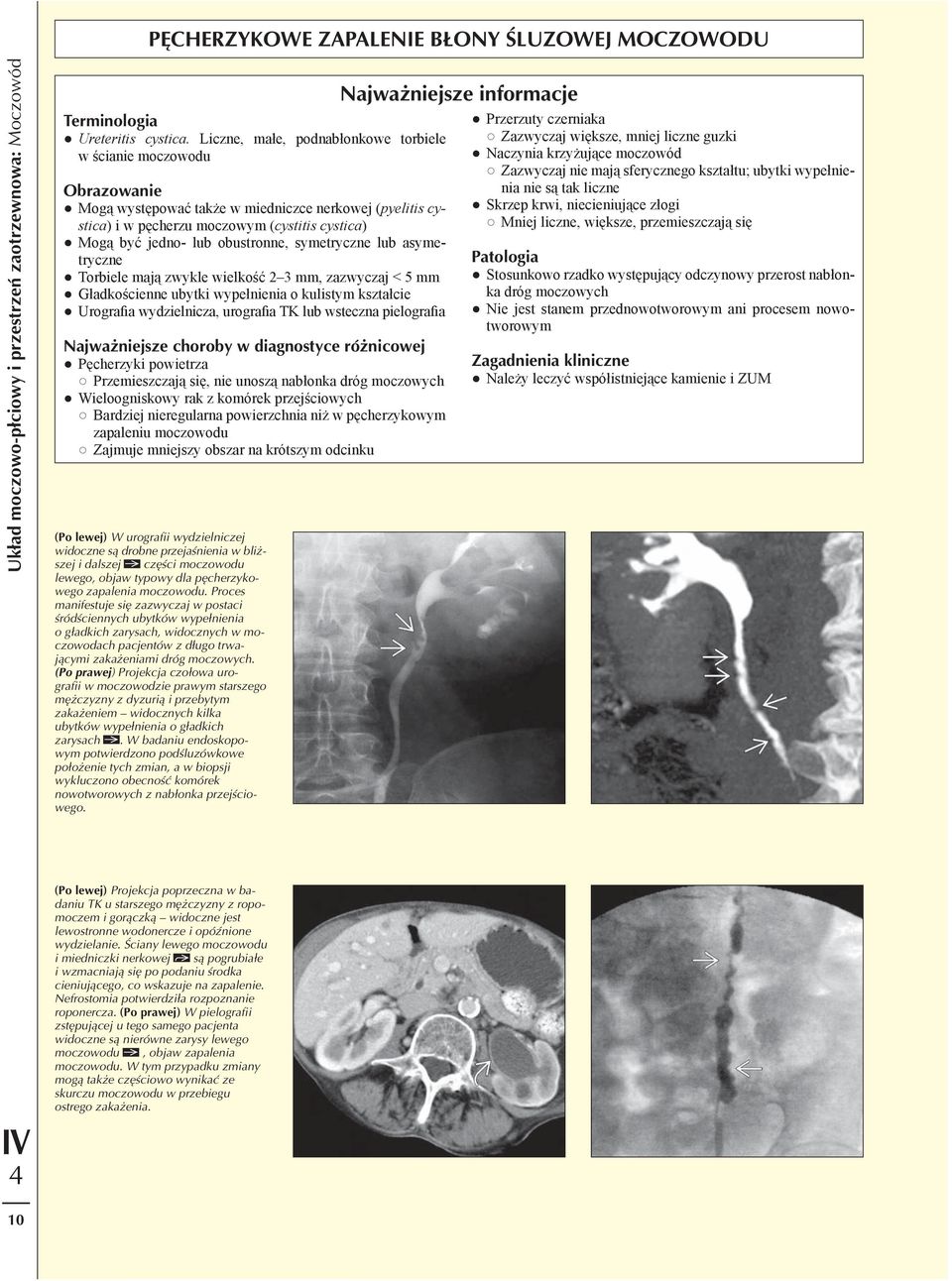 obustronne, symetryczne lub asymetryczne Torbiele mają zwykle wielkość 2 3 mm, zazwyczaj < 5 mm Gładkościenne ubytki wypełnienia o kulistym kształcie Urografia wydzielnicza, urografia TK lub wsteczna