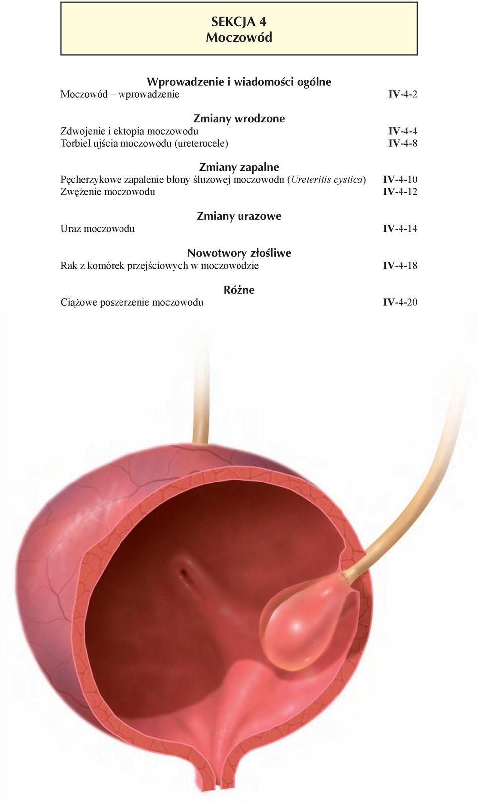 śluzowej moczowodu (Ureteritis cystica) Zwężenie moczowodu --2 -- --8 --10 --12 Uraz moczowodu Zmiany