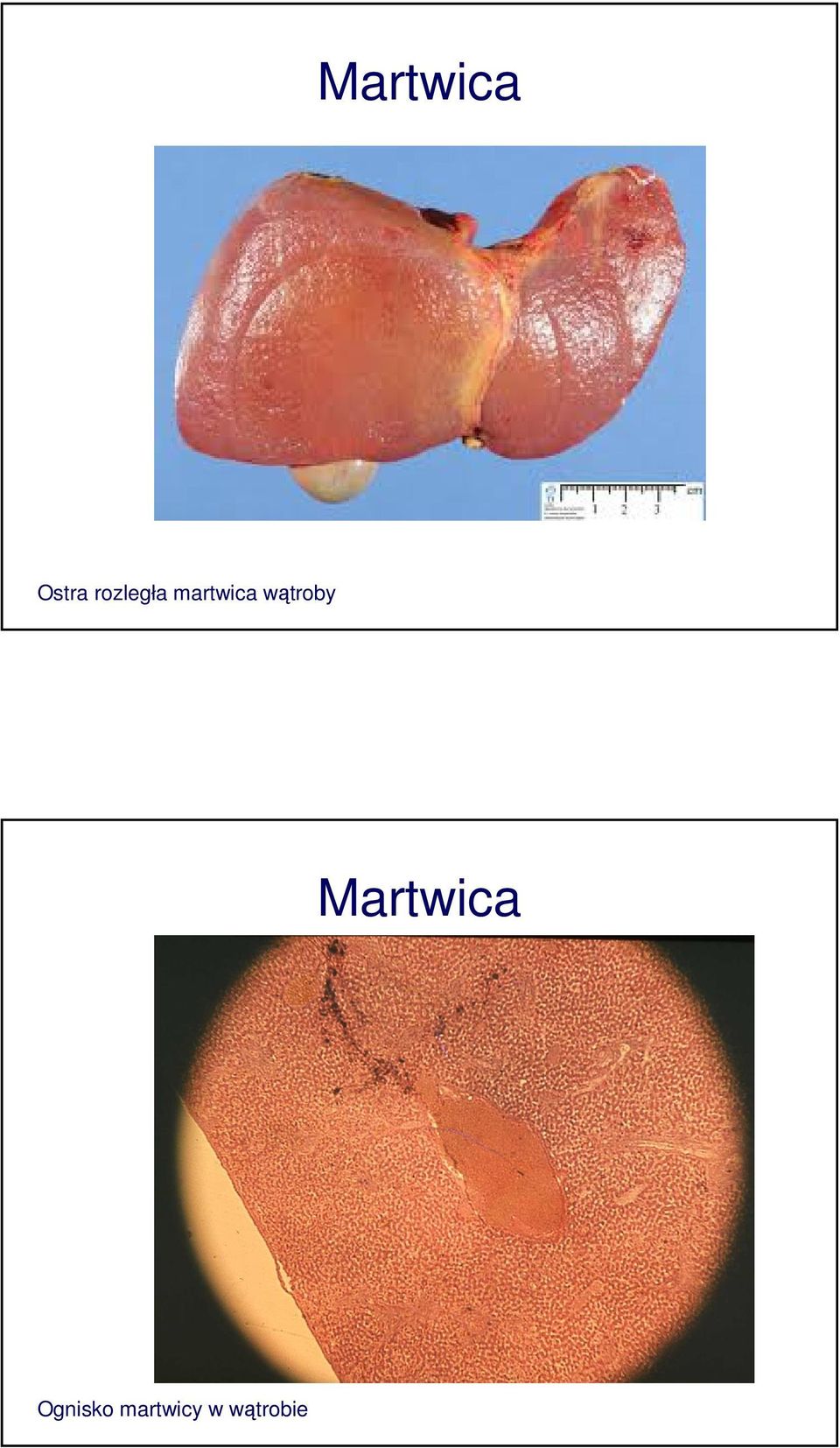 wątroby Martwica