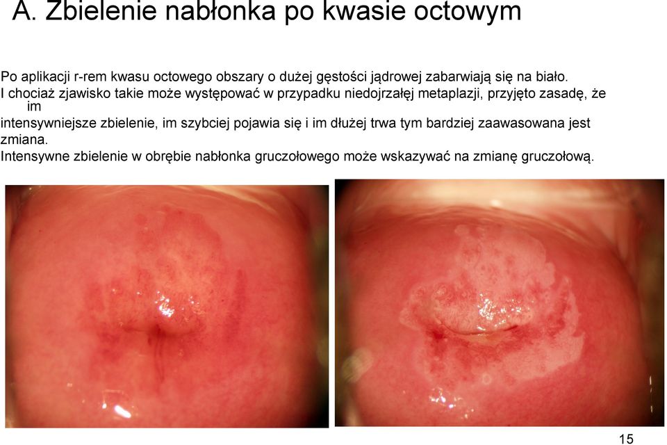 I chociaż zjawisko takie może występować w przypadku niedojrzałęj metaplazji, przyjęto zasadę, że im