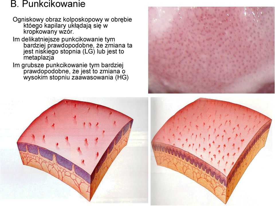 Im delikatniejsze punkcikowanie tym bardziej prawdopodobne, że zmiana ta jest