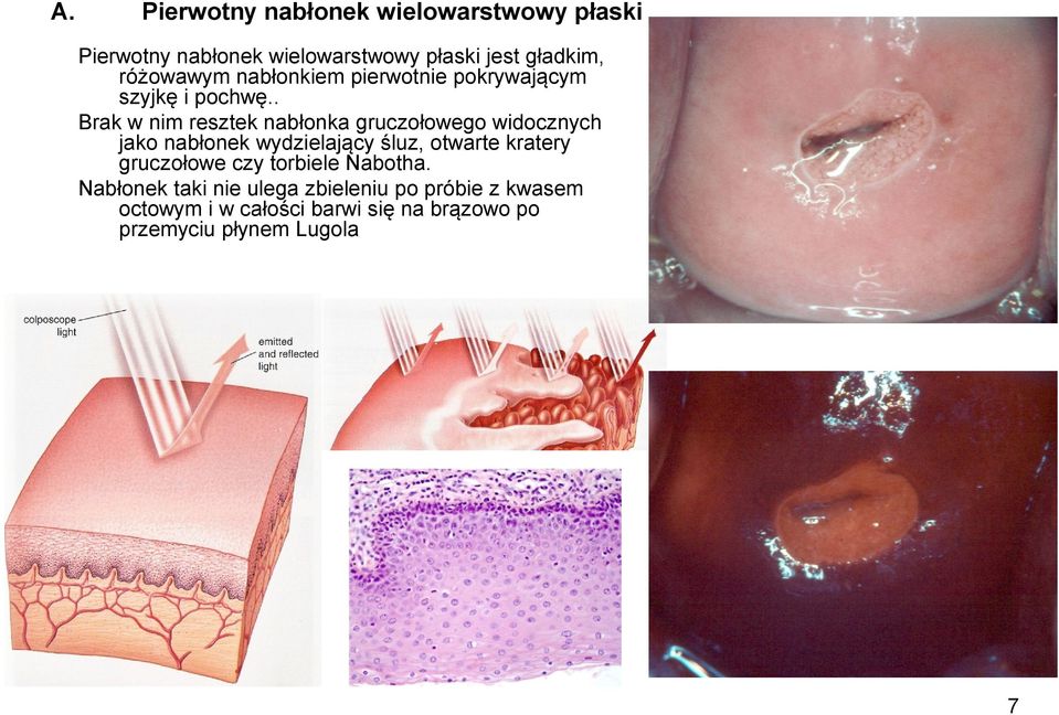 . Brak w nim resztek nabłonka gruczołowego widocznych jako nabłonek wydzielający śluz, otwarte kratery