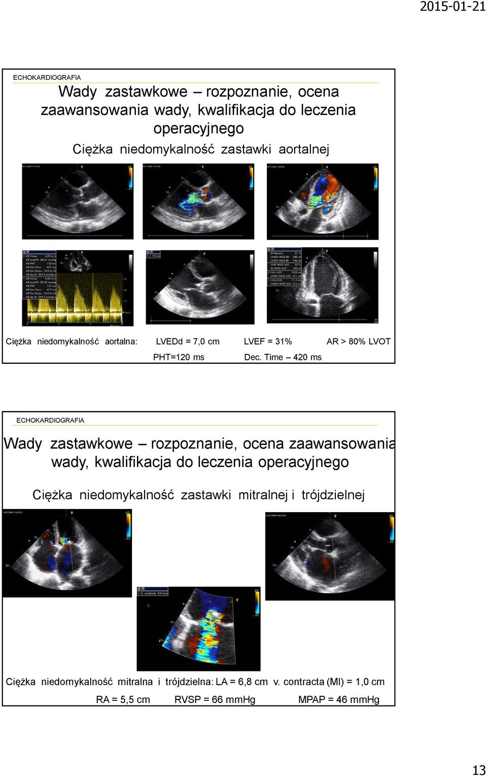 Time 420 ms  mitralnej i trójdzielnej Ciężka niedomykalność mitralna i trójdzielna: LA = 6,8 cm v.