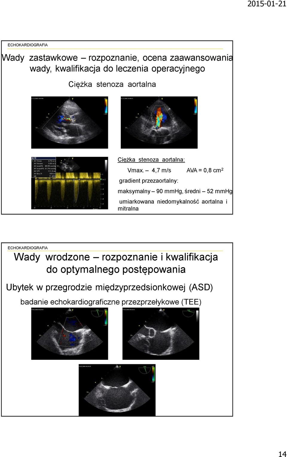 4,7 m/s AVA = 0,8 cm 2 gradient przezaortalny: maksymalny 90 mmhg, średni 52 mmhg umiarkowana niedomykalność