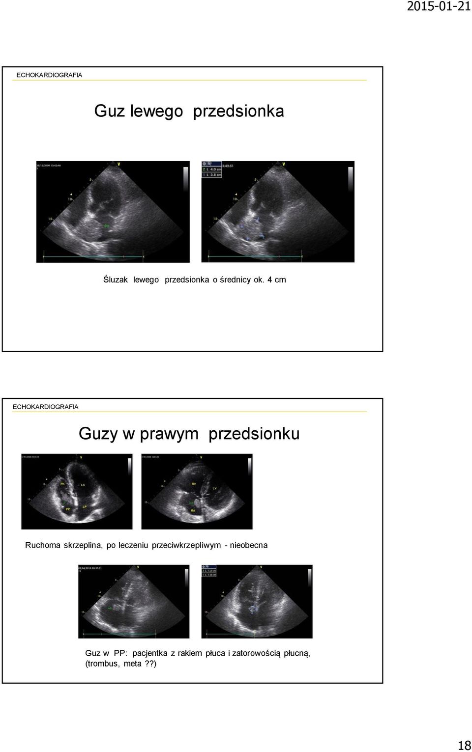 4 cm Guzy w prawym przedsionku Ruchoma skrzeplina, po