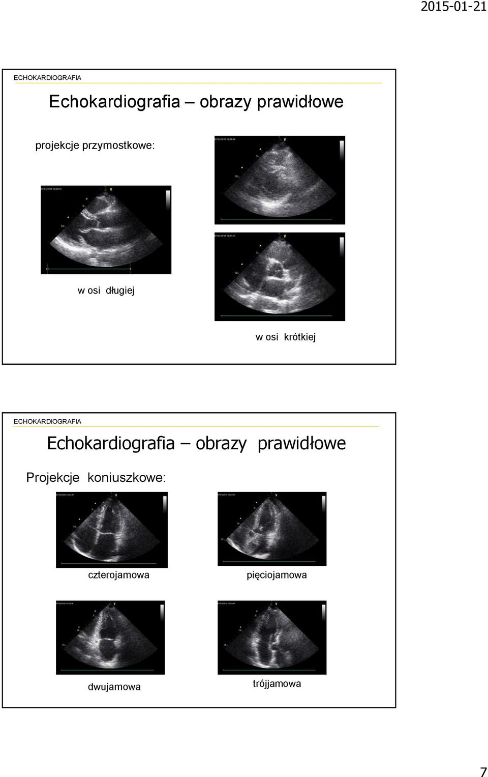 Echokardiografia obrazy prawidłowe Projekcje