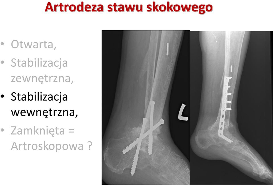 zewnętrzna, Stabilizacja