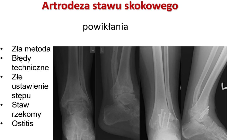 stępu Staw rzekomy Ostitis