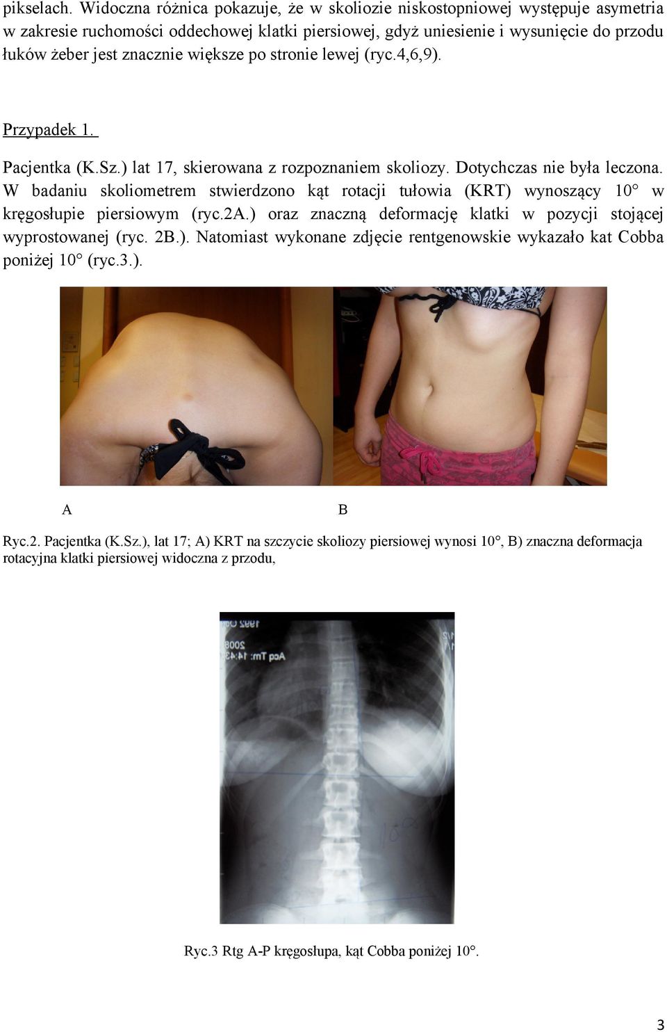 większe po stronie lewej (ryc.4,6,9). Przypadek 1. Pacjentka (K.Sz.) lat 17, skierowana z rozpoznaniem skoliozy. Dotychczas nie była leczona.