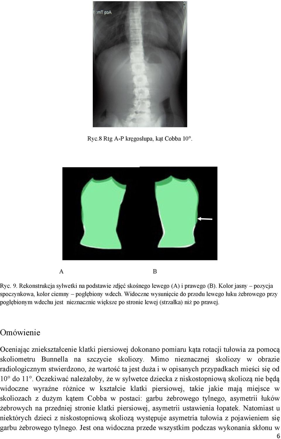 Omówienie Oceniając zniekształcenie klatki piersiowej dokonano pomiaru kąta rotacji tułowia za pomocą skoliometru Bunnella na szczycie skoliozy.