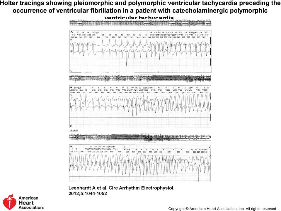 catecholaminergic polymorphic ventricular tachycardia. Leenhardt A et al.