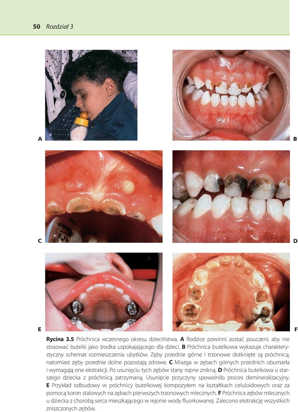 C Miazga w zębach górnych przednich obumarła i wymagają one ekstrakcji. Po usunięciu tych zębów stany ropne znikną. D Próchnica butelkowa u starszego dziecka z próchnicą zatrzymaną.
