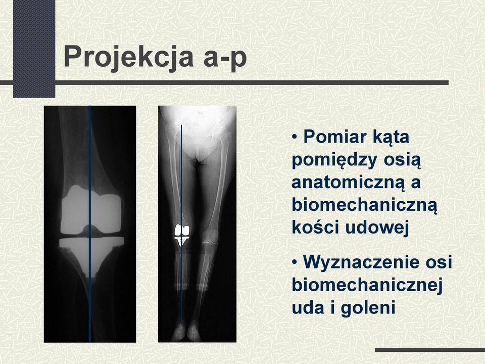 biomechaniczną kości udowej