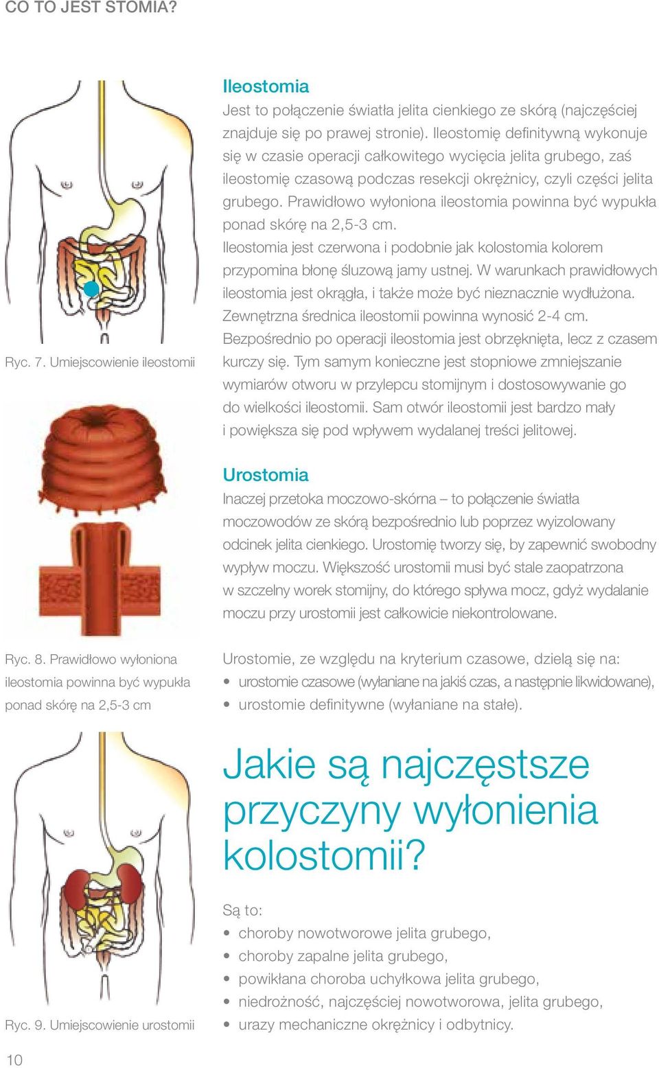 Prawidłowo wyłoniona ileostomia powinna być wypukła ponad skórę na 2,5-3 cm. Ileostomia jest czerwona i podobnie jak kolostomia kolorem przypomina błonę śluzową jamy ustnej.