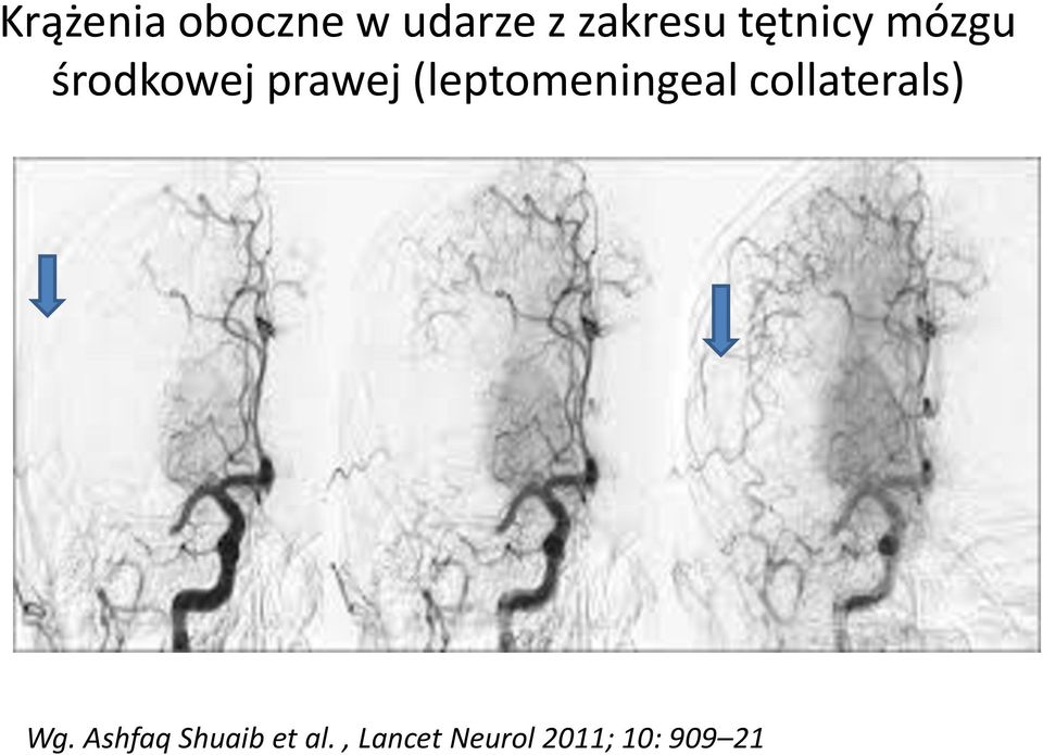 (leptomeningeal collaterals) Wg.